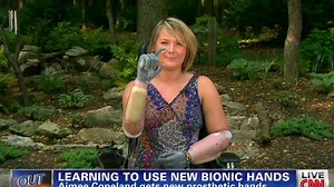 Aimee Copeland shows off her new hands
