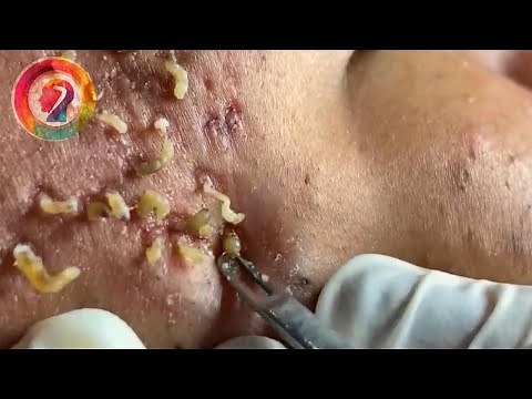 Ultimate Pimple Popping 2024: Satisfying Blackhead Extractions & Acne Solutions