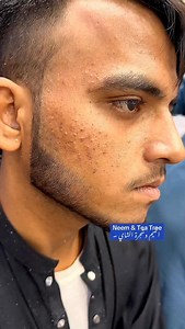 14K views · 75 reactions | Glow & Clean Anti Acne Ampule & Tea Tree Face Wash Amazing #ameenbeautytips | Ameenbeautytips | Facebook