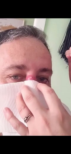 Pimple Popping: Blackheads, Zits & Acne Removal