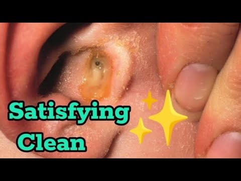 Extreme Earwax Removal | Satisfying Deep Ear Cleaning | Huge Ear Wax Extraction Compilation