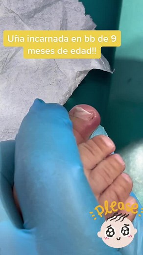#podologiainfantil #bb #baby #podoatrist #podologo #madre #padres #hijos #salud #consultorio #uñaincarnada #uñaenterrada