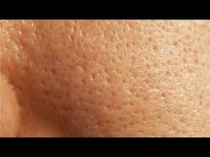 how to get rid of large pores on nose