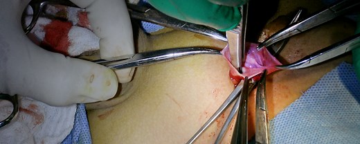 Pediatric Bilateral Indirect Inguinal Herniotomy | Journal of Medical Insight