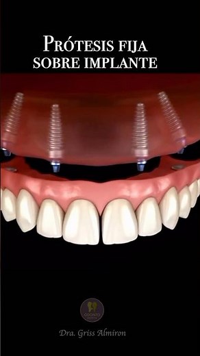 Prótesis dental dental completa sobre implantes ✨Esta sonrisa se sostiene sobre 4 implantes 🦷💎
