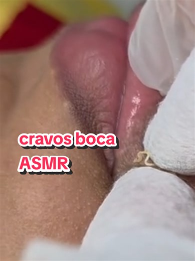 Cravo na boca? Nada resiste a uma limpeza de pele profissional bem feita! A extração foi precisa, segura e o resultado é aquela pele lisinha que a gente ama ver - e mais ainda sentir. Se você também acha esses vídeos satisfatórios, já deixa seu comenta o que achou e segue o perfil para acompanhar mais transformações reais! #acnetreatment #pimple #fyp #skincare #viral