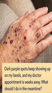 664K views · 1.4K reactions | Dark purple spots keep showing up on my hands, and my doctor appointment is weeks away. What should I do in the meantime? | Health Tips Tricks | Facebook