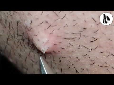 Pulling out ingrown hair