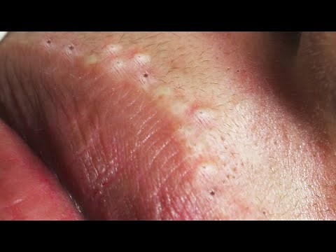 Daily Video Relaxing with Sophia Skin Care, Acne, Whiteheads & Blackheads #049