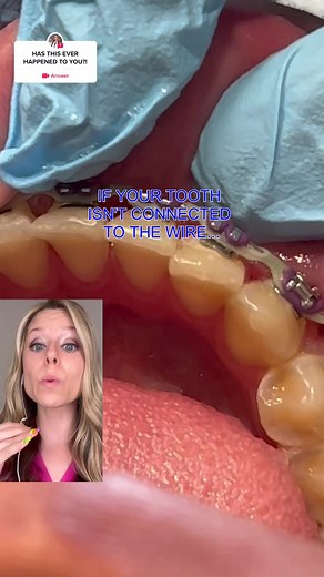 Broken Braces: Consequences and Solutions Explained