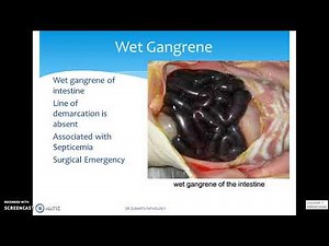 DIFFERENT TYPES OF GANGRENE