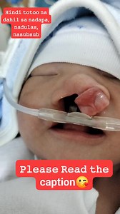 2.1M views · 59K reactions | Fact about #cleftpalate Causes Cleft...