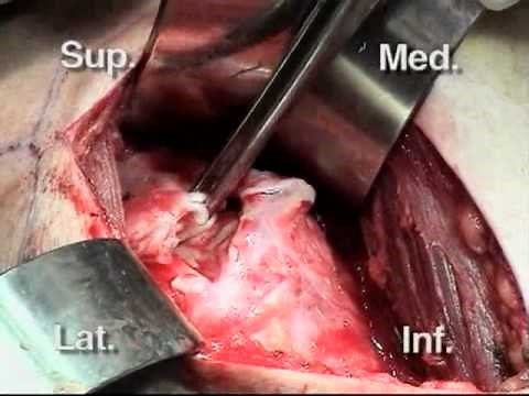 Shoulder Surgery: Open Rotator Cuff Repair