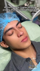 12K views · 35 reactions | Our Signature Tinkerbell Nose Lift ✨ Promor price ₱9,999 This procedure gives more Nasal Tip Projection achieving pointed nose. It is non-surgical procedure with minimal downtime and will give a natural-looking nose results.  #alagangtheglutalounge #alagangkateyap #nosethreadlift #threadlift #tinkerbellnose #pointednose #nonsurgicalrhinoplasty | The Gluta Lounge & Aesthetic Center - Quezon City | Facebook