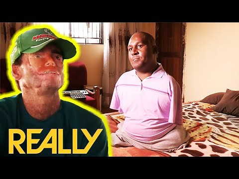 The Most Bizarre & Rare Medical Conditions In The World | Body Bizarre