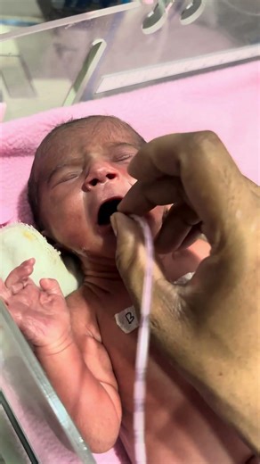 How a Newborn Baby Is Being Given an NG Tube in the NICU #NewbornBaby #NGTube #NasogastricTube
