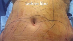 Liposuction Before & After: See This Woman's New Hourglass Figure