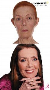 Coreen Cronje's skin transformation journey at Skin Renewal is truly inspiring! To address her concerns of severe volume loss, sagging skin, and ingrained wrinkles, Coreen underwent a combination of advanced treatments tailored to her unique needs. Her treatment plan included Dermal Fillers, Botulinum Toxin, Silhouette Soft® Neck Lift, PDO Anchor Threads, Jett Plasma Eye Rejuvenation, and more. Together with Carboxytherapy, Laser Genesis™ Rejuvenation, and Photo Dynamic Therapy (PDT), Coreen saw