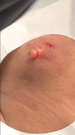 SHORT: BUTTOCK CYST