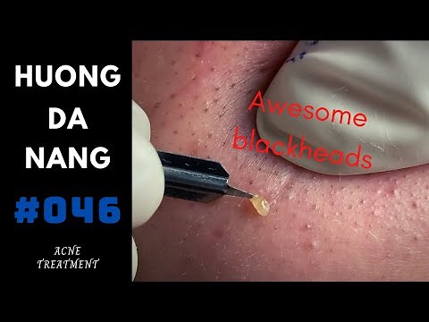 #046 | Awesome blackheads | mụn đầu đen tuyệt vời | Acne treatment Hương Đà Nẵng Official