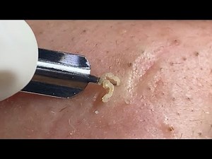 Huong Da Nang Acne Treatment #343