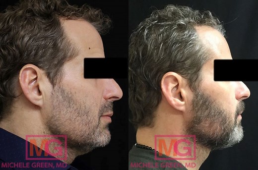 Aging Neck Treatments, Kybella, Botox & Fat Removal For The Turkey Neck