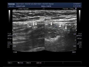 Normal Appendix, and Rt. Salpingitis with Lt. Ovarian Chocolate Cyst.