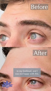 Anti-Wrinkle Injections reduce the appearance of lines to produce a look that is fresh, more youthful, and most importantly, natural. Book your free consultation today https://www.therapieclinic.com/ie/cosmetic-injections/anti-wrinkle-injections-women/ #antiwrinkleinjections #botox #antiwrinkle #therapie #therapieclinic #reel #fyp #foryoupage #explorepage #explore #reels #trending #experience #testimonial #reallifeexperience | Thérapie Clinic UK | Facebook