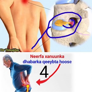 178K views · 1.7K reactions | Waa maxay Sciatica ?? | 헗헥 헧헜헠헔헝헜헟헔헖 | Facebook