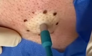 Big Sebaceous Cyst Popped