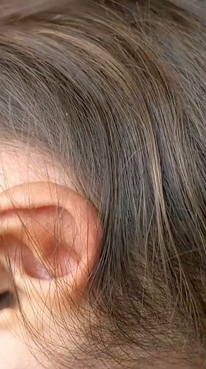 1.2K views | Removing all hundred lice from her head | Restore Machines | Facebook