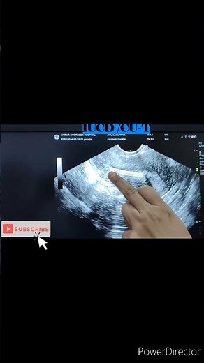 IUCD #Copper T in situ#coppert #mirena #intrauterindevice#ultrasound #usgpelvis#tvs