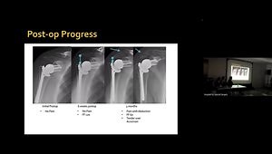 Case Presentation: Fractures of the Acromion and Scapular Spine After RSA