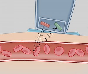 Vidéo: Examen vasculaire périphérique à l’aide d’un Doppler à ondes continues