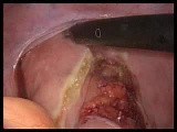 Laparoscopic Posterior Mesh Rectopexy for Prolapse of Rectum • Video • MEDtube.net