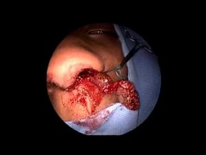 Functional endoscopic sinus surgery (FESS) was done by Dr.Osama Marglani