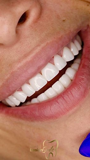 At our dental clinic, we take pride in providing personalized solutions for patients with missing teeth. Don't let the absence of teeth stop you from smiling with confidence! 💎 With our porcelain veneers, crowns, and bridges, we can restore the natural appearance of your teeth, giving you a radiant and long-lasting smile. | Dental Design Smile