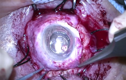 A video shows the steps involved in transplanting an autograft of the entire bulbar ocular surface from one eye to the other eye. | The New England Journal of Medicine