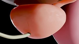 Benign prostatic, Enlargement and inflammation of the prostate, hypertrophy, hyperplasia (BPH), male reproductive system, bladder anatomy, urology, enlarged prostate gland, Prostatitis, 3d render