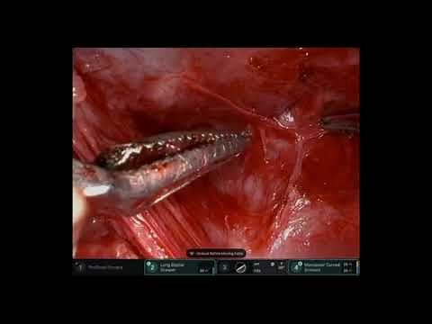 Robotic Radical Prostatectomy using the DV5 robot