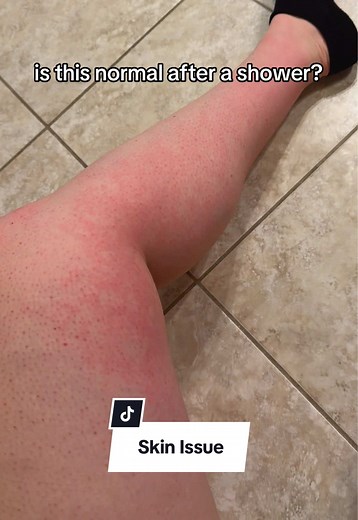 MCAS Rash on Legs After Shower: Understanding Skin Issues