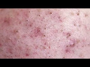 Make your Acne Treatment Huong Da Nang | 480# acne 2022