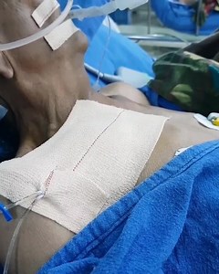 - Kussmaul sign is a paradoxical rise in jugular venous pressure (JVP) on inspiration, or a failure in the appropriate fall of the JVP with inspiration. It can be seen in some forms of heart disease and is usually indicative of limited right ventricular filling due to right heart dysfunction. Ordinarily the JVP falls with inspiration due to reduced pressure in the expanding thoracic cavityand the increased volume afforded to right ventricular expansion during diastole. Kussmaul sign suggests imp