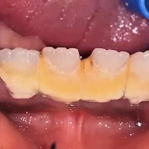 Removing calculus ⛏ . . . . Via: @doktergigi_ | Dentistry blog | Facebook
