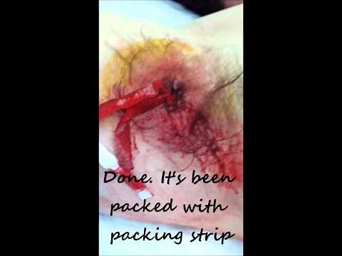 GRAPHIC!! Boil/Abscess Being Drained & Packed