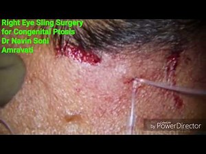 Ptosis Surgery-Sling
