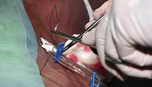 Central venous catheter (CVC): placement, management, and guidelines