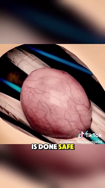 Ganglion Cyst Removal Explained with 3D Animation
