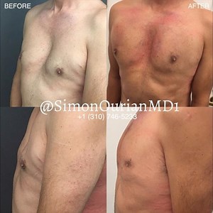 Exclusively available at EPIONE® Beverly Hills Nonsurgical Male chest...