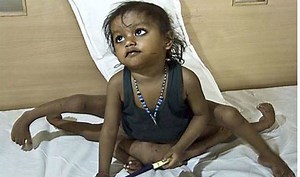 Lakshmi Tatma (Girl With 8 Limbs) ~ Bio with [ Photos | Videos ]